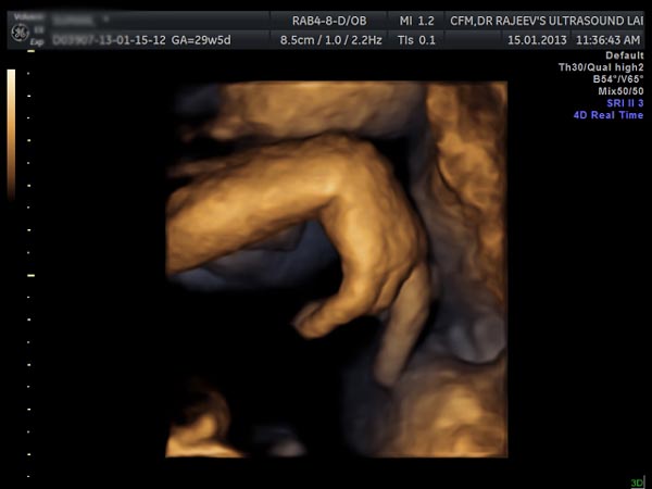 3D-4D Ultrasound