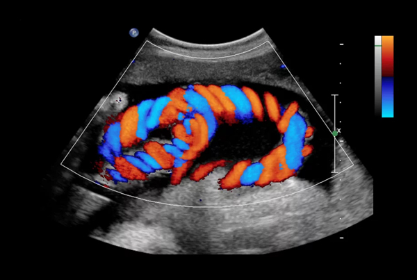 Color Doppler