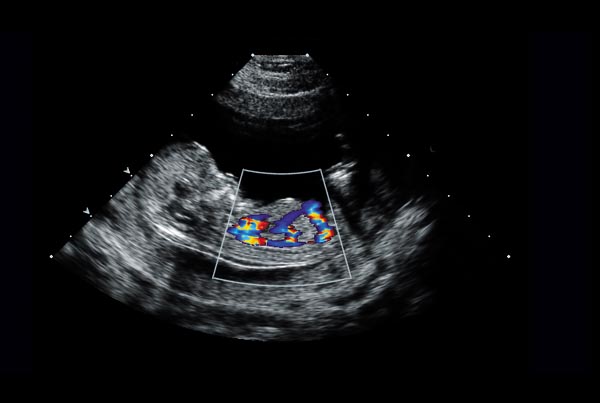 Fetal ECHO Cardiography