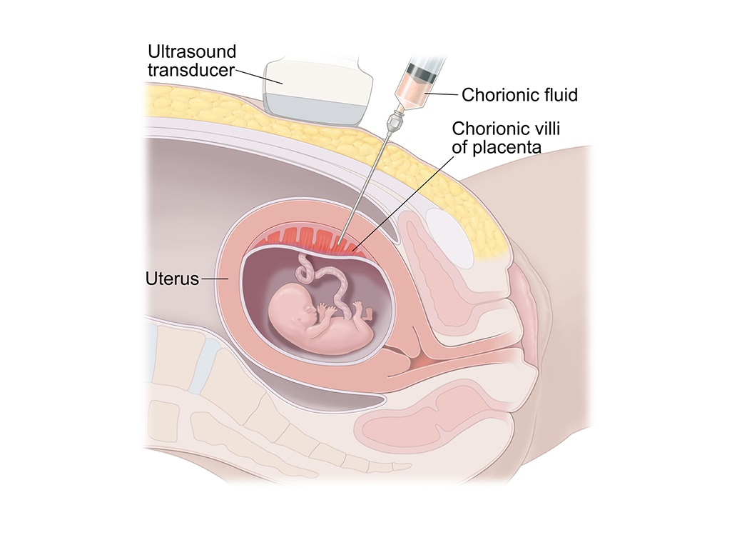 Prenatal Invasive Test (Aminocentesis/CVS)